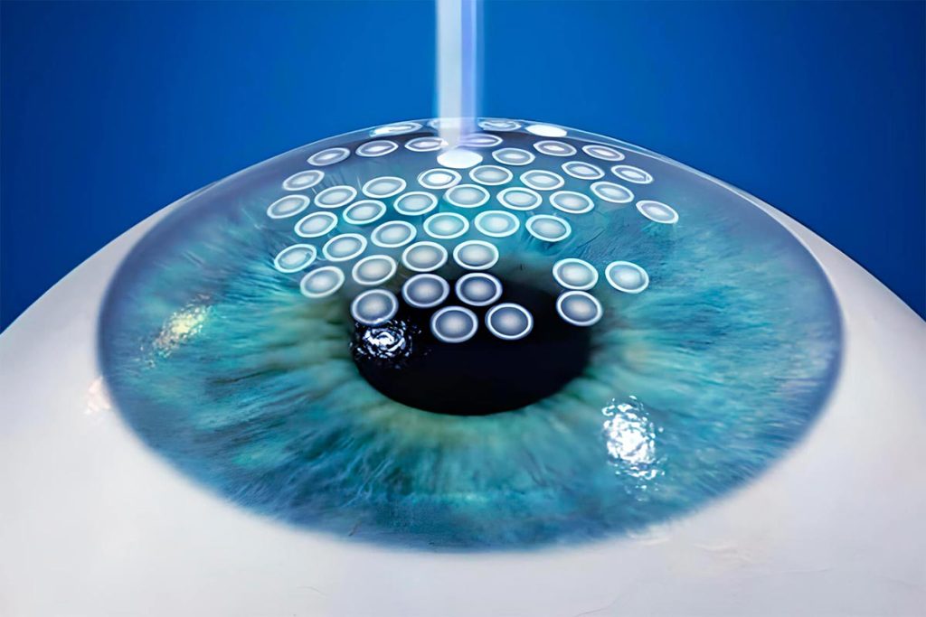 Hard-to-Fit Contact Lenses