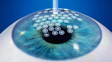 What Are Hard-to-Fit Contacts and Who Needs Them?